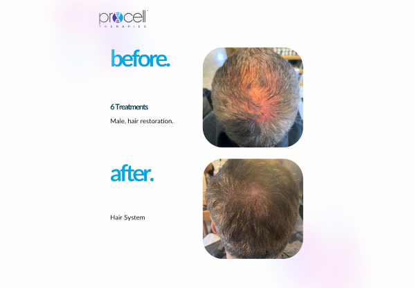 Maintenance, Home Care, and Results