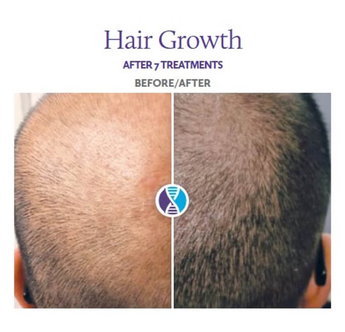 Procell Hair / Thinning